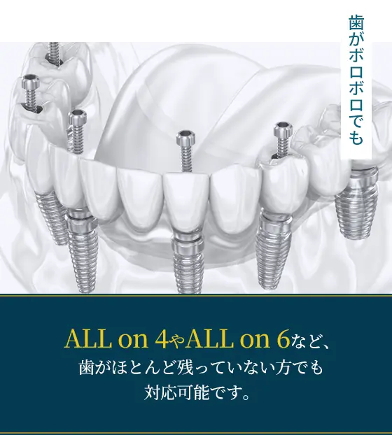 歯がボロボロでもALLon4やALLon6など、歯がほとんど残っていない方でも対応可能です。